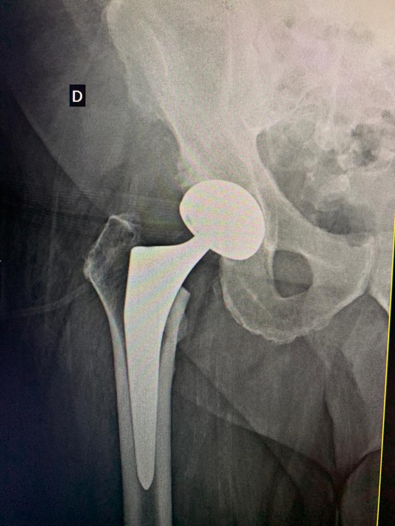 10% das próteses realizadas nos EUA são devido Necrose Avascular da Cabeça do Fêmur